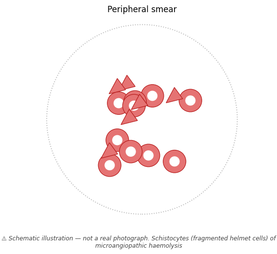 Schistocytes (fragmented helmet cells) of microangiopathic haemolysis