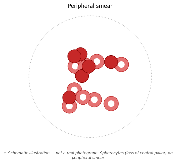Spherocytes (loss of central pallor) on peripheral smear
